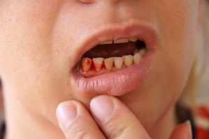 bleeding gums orthodontist info