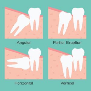 wisdom teeth