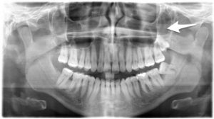 wisdom tooth