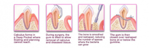 periodontal disease