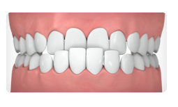 ortho-for-underbite-nyc-ny-04