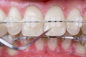 best-nyc-orthodontist-for-ceramic-braces-02