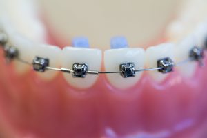 top-orthodontist-for-damon-braces-03