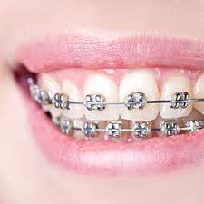 braces-for-underbite-best-orthodontist-nyc-02