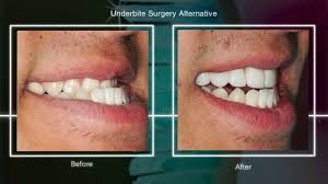 orthodontist-for-severe-underbite-options-top-nyc-expert-01
