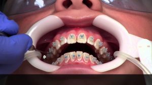process-getting-braces-info-nyc-top-orthodintist-01