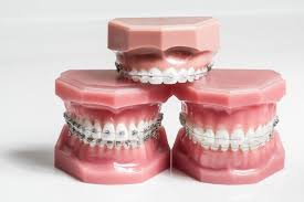 orthodontist-nyc-teeth-straightening-retainers-braces-info-03