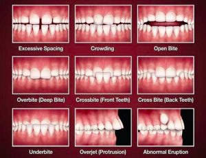 malocclusion-teeth-misalignment-nyc-orthodontic-specialists-02