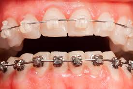 clear-vs-metal-braces-top-nyc-orthodontist-specialist-01