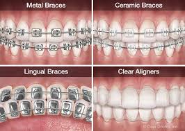 examples-modern-orthodontics-braces-03