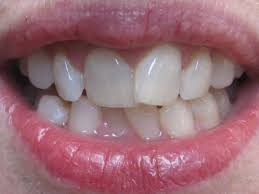 options-costs-straighten-teeth-info-01