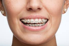 top-nyc-orthodontist-adult-orthodontics-braces-01