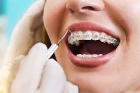 tradional-braces-adult-orthodontics-03