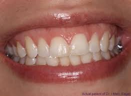 teenager-straight-teeth-benefits-orthodontist-03