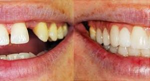 causes-of-crooked-teeth-02