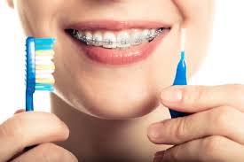 oral-hygeine-braces-orthodontics-03