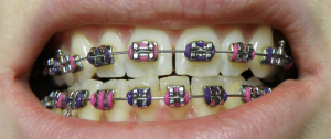 Average Cost of Braces NY