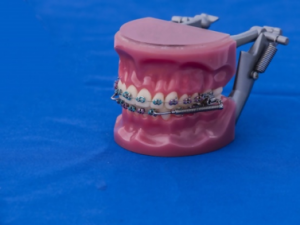 Average Cost of Metal Braces | Orthodontist NYC