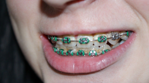 Process of kid getting braces
