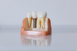 Tooth Anatomy & Common Problems