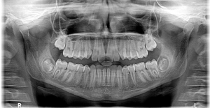 Different Types of Orthodontic Emergencies