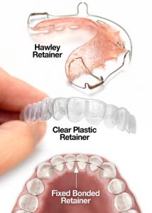 teeth-dental-retention-retainers-types