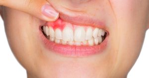 gingivitis