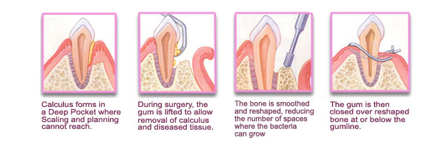 periodontal disease