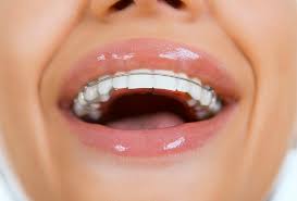 retainers-for-underbite-problems-ortho-specialist-03