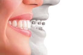orthodontic-braces-aligners-info-faq-top-nyc-ortho-02