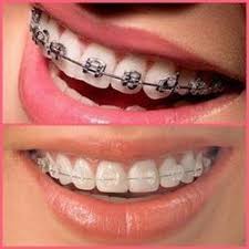 Average Cost of Braces - Best Orthodontist NYC