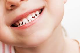 braces-for-children-straighten-teeth-info-02