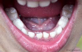 braces-for-kids-info-orthodontist-01