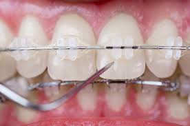 ceramic-braces-close-up-pic-general-information-02