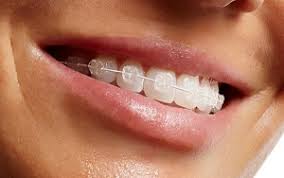 Average Cost of Braces - Best Orthodontist NYC