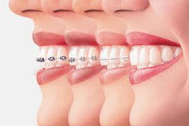 What Are Ceramic Braces?, Pros & Cons of Ceramic Braces