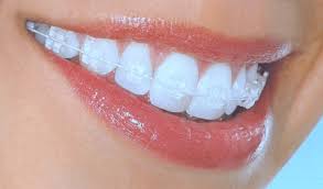 clear-braces-general-information-03