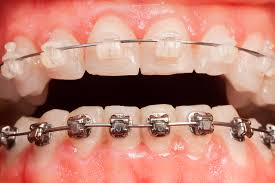 Ceramic Braces, Advantages, Costs & More