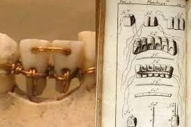 history-of-orthodontics-braces-02