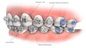 orthodontist-options-braces-costs-03