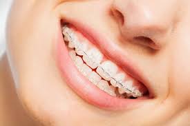 Ceramic Braces - Best Orthodontist NYC