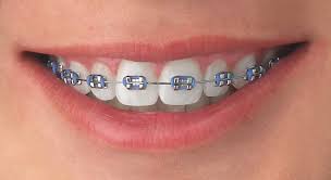 traditional-metal-braces-information-02