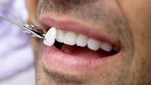 veneers-orthodontist-information-nyc-01