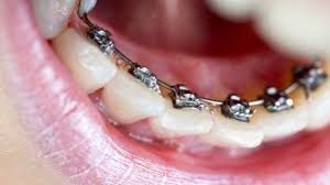 best-treatment-crooked-teeth-03