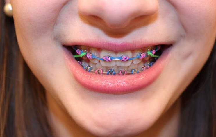 best-braces-for-children-girls-nyc-orthodontist-02