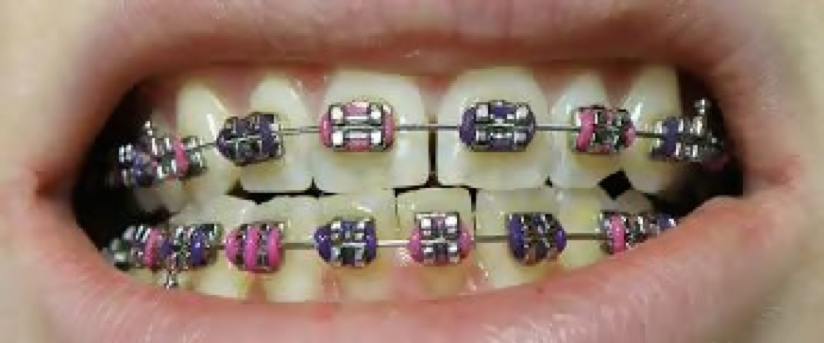 braces-for-adults-01