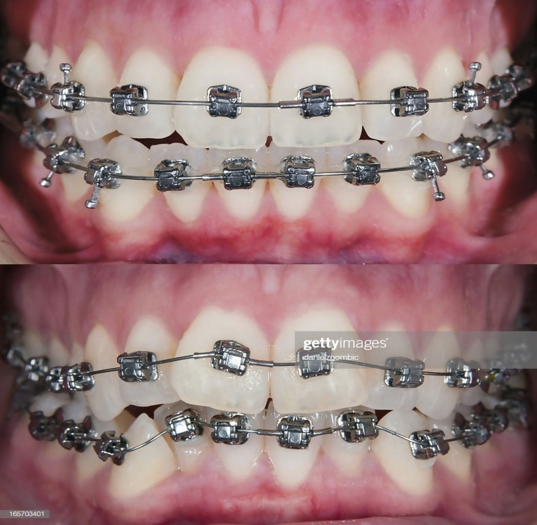 Orthodontic Trends 2020
