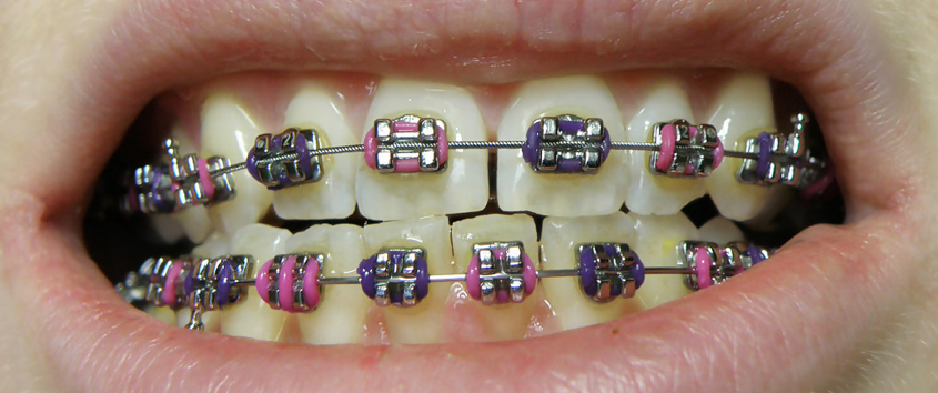 How Much Do Braces Cost?  Lakemoor Dental & Orthodontics