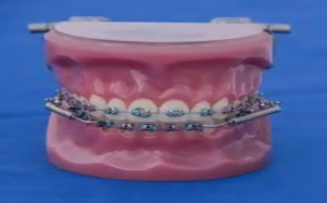 What is Accelerated Orthodontics?