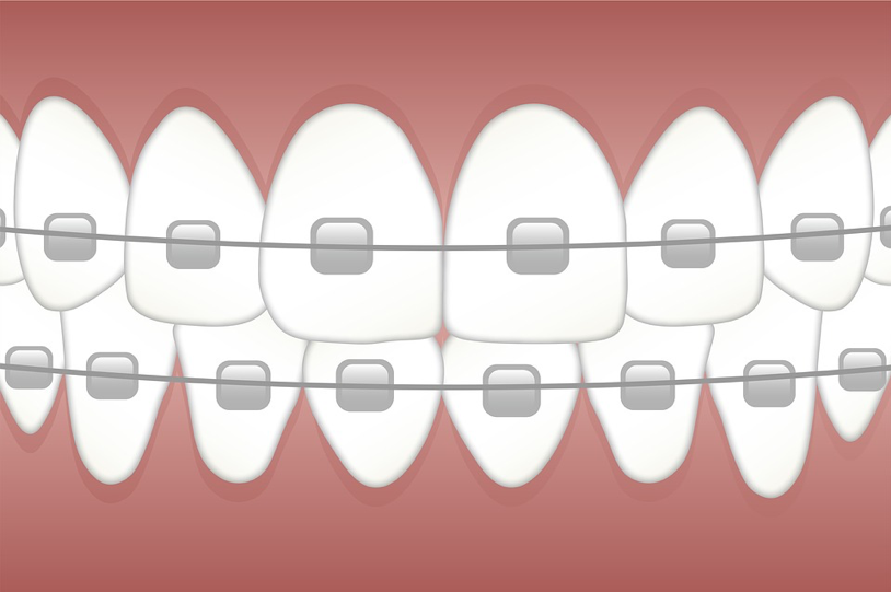 Ceramic Braces for the Teeth